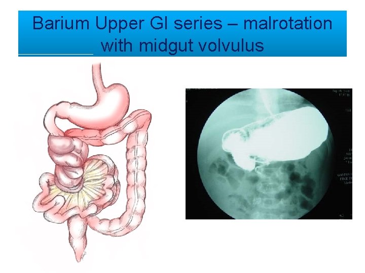 Barium Upper GI series – malrotation with midgut volvulus 