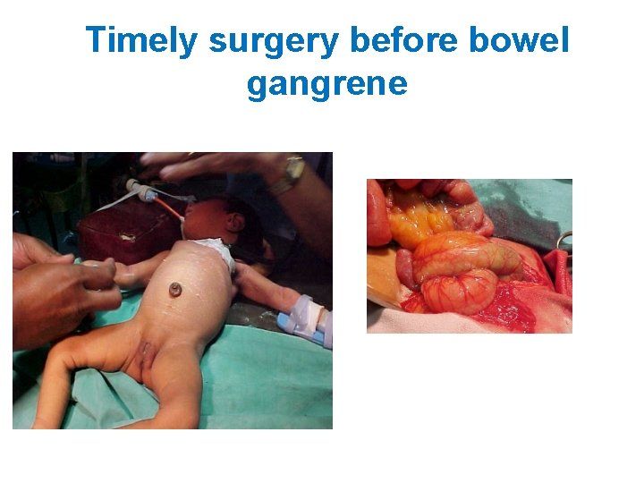 Timely surgery before bowel gangrene 