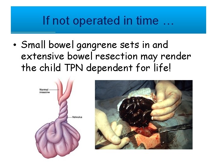 If not operated in time … • Small bowel gangrene sets in and extensive