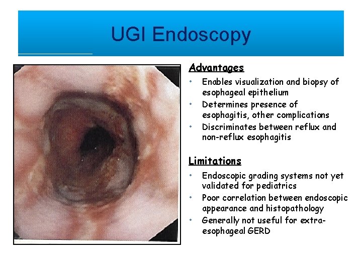 UGI Endoscopy Advantages • • • Enables visualization and biopsy of esophageal epithelium Determines