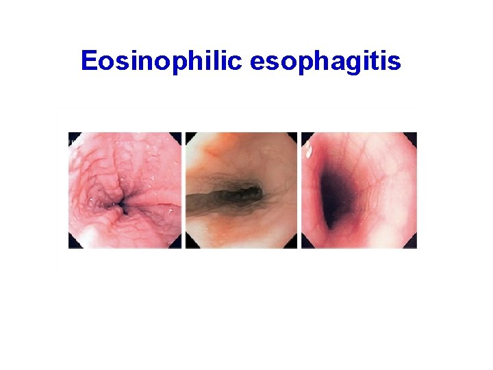 Eosinophilic esophagitis 