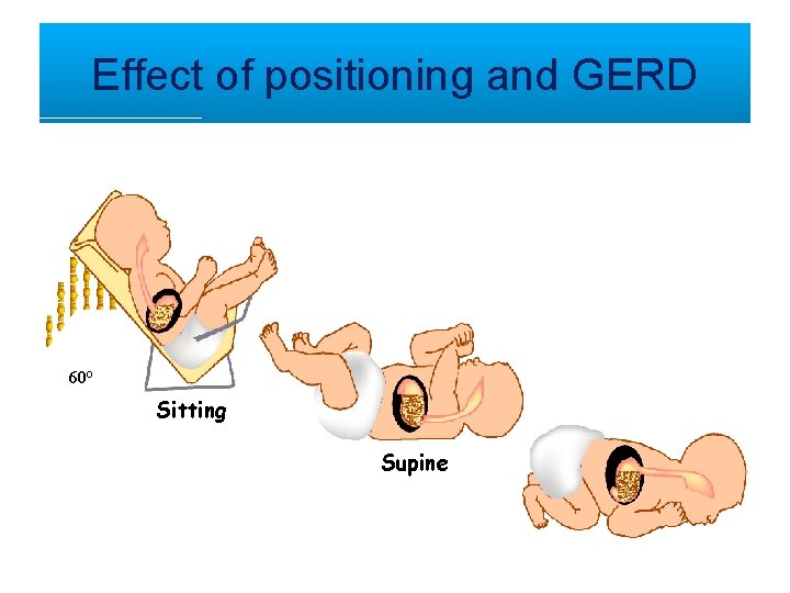 Effect of positioning and GERD 60° Sitting Supine 