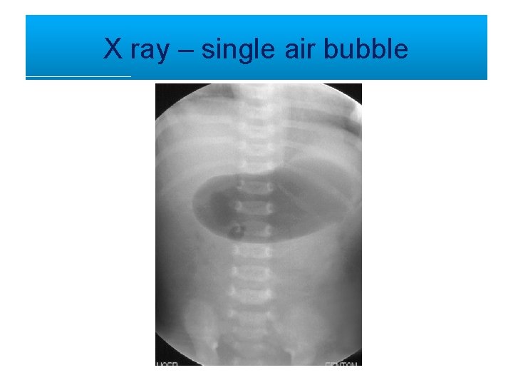 X ray – single air bubble 