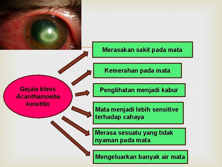  Merasakan sakit pada mata Kemerahan pada mata Gejala klinis Acanthamoeba keratitis Penglihatan menjadi