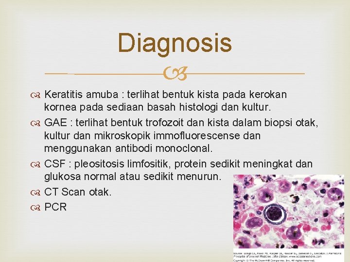 Diagnosis Keratitis amuba : terlihat bentuk kista pada kerokan kornea pada sediaan basah histologi