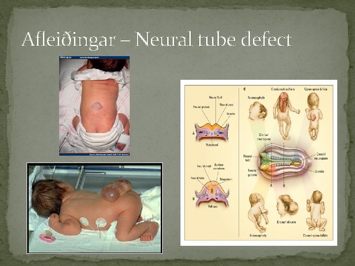 Afleiðingar – Neural tube defect 