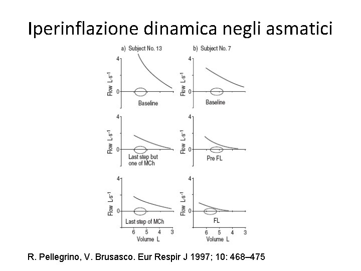 Iperinflazione dinamica negli asmatici R. Pellegrino, V. Brusasco. Eur Respir J 1997; 10: 468–