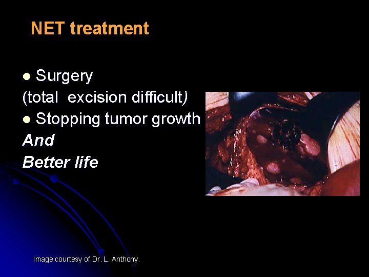NET treatment Surgery (total excision difficult) l Stopping tumor growth And Better life l