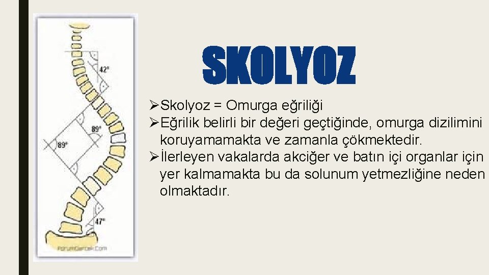 SKOLYOZ ØSkolyoz = Omurga eğriliği ØEğrilik belirli bir değeri geçtiğinde, omurga dizilimini koruyamamakta ve