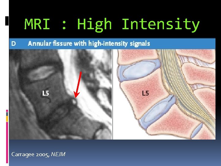 MRI : High Intensity Zone Carragee 2005, NEJM 