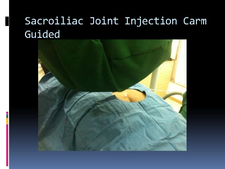 Sacroiliac Joint Injection Carm Guided 