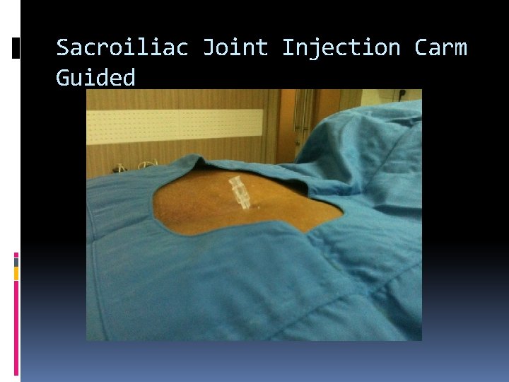 Sacroiliac Joint Injection Carm Guided 