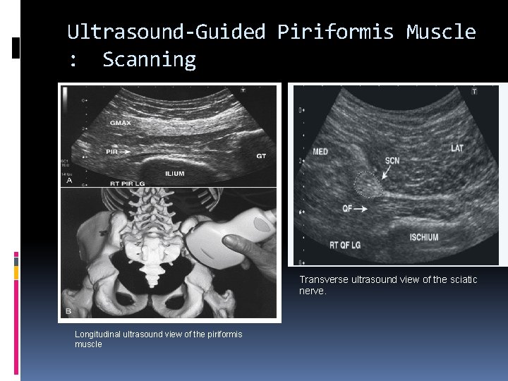 Ultrasound-Guided Piriformis Muscle : Scanning Transverse ultrasound view of the sciatic nerve. Longitudinal ultrasound