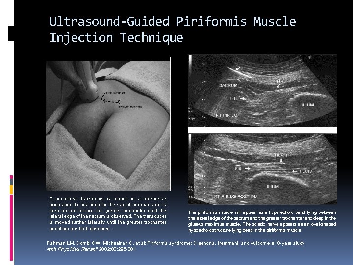 Ultrasound-Guided Piriformis Muscle Injection Technique A curvilinear transducer is placed in a transverse orientation