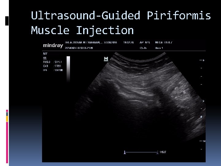 Ultrasound-Guided Piriformis Muscle Injection 
