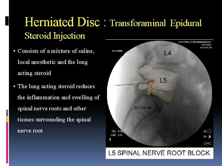Herniated Disc : Transforaminal Steroid Injection • Consists of a mixture of saline, local