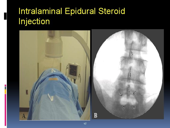 Intralaminal Epidural Steroid Injection 45 