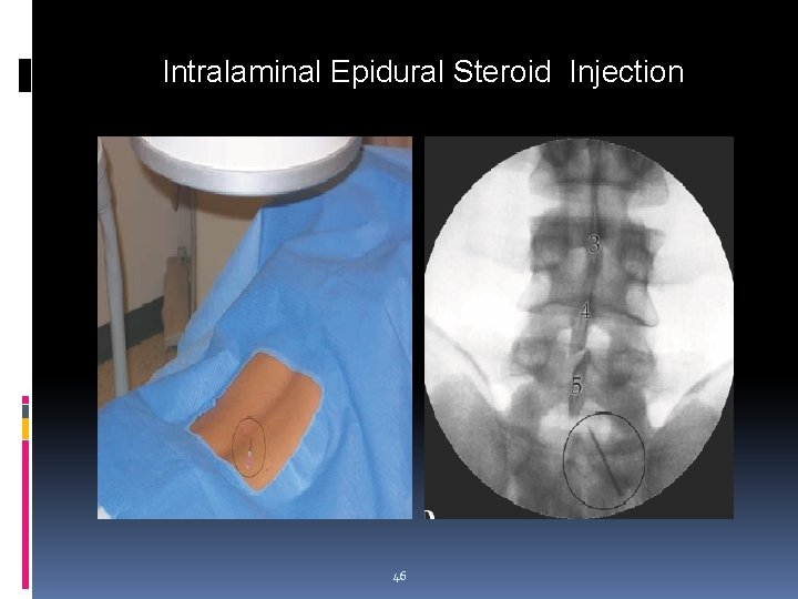 Intralaminal Epidural Steroid Injection 46 