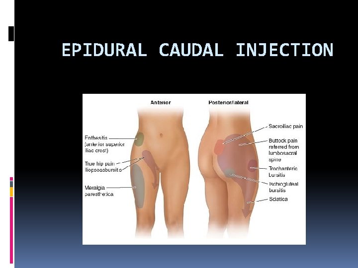 EPIDURAL CAUDAL INJECTION 