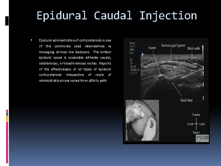 Epidural Caudal Injection Epidural administration of corticosteroids is one of the commonly used interventions