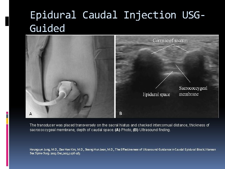 Epidural Caudal Injection USGGuided The transducer was placed transversely on the sacral hiatus and