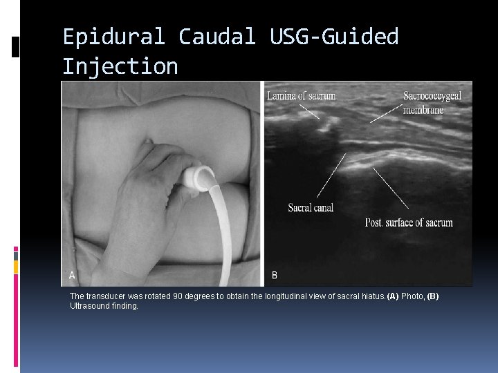 Epidural Caudal USG-Guided Injection The transducer was rotated 90 degrees to obtain the longitudinal