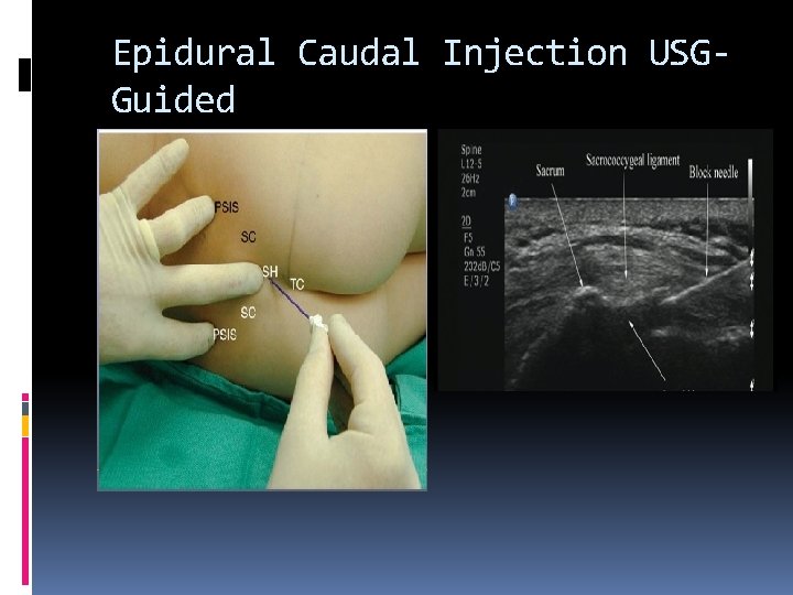 Epidural Caudal Injection USGGuided 