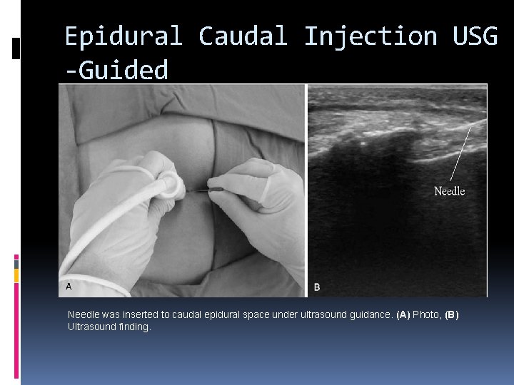 Epidural Caudal Injection USG -Guided Needle was inserted to caudal epidural space under ultrasound