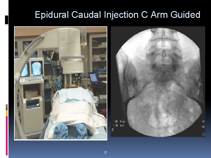 Epidural Caudal Injection C Arm Guided 57 