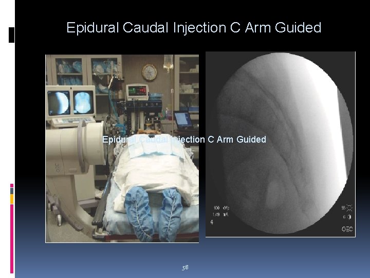 Epidural Caudal Injection C Arm Guided 58 