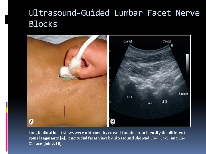 Ultrasound-Guided Lumbar Facet Nerve Blocks Longitudinal facet views were obtained by curved tranducer to