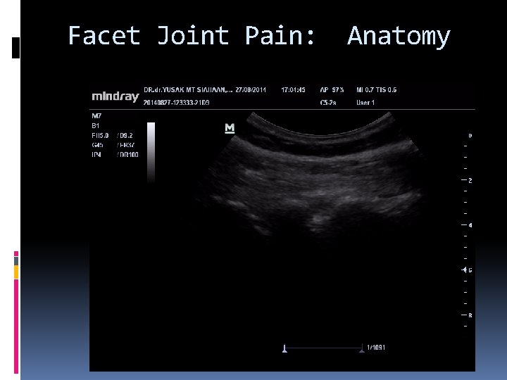 Facet Joint Pain: Anatomy 