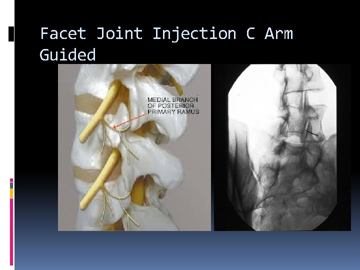 Facet Joint Injection C Arm Guided 