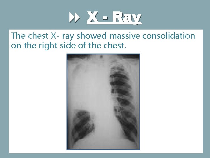  X - Ray The chest X- ray showed massive consolidation on the right