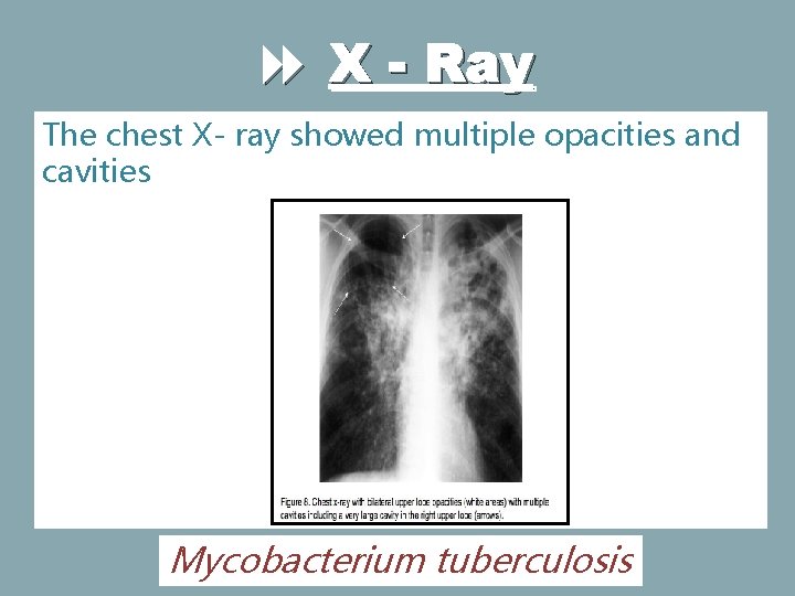 X - Ray The chest X- ray showed multiple opacities and cavities Mycobacterium