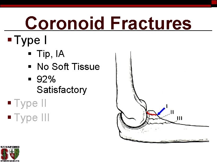 Coronoid Fractures § Type I § Tip, IA § No Soft Tissue § 92%