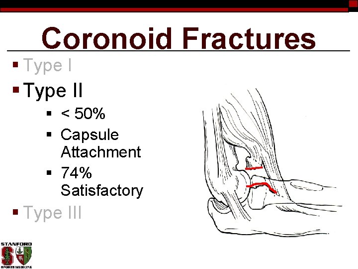 Coronoid Fractures § Type II § < 50% § Capsule Attachment § 74% Satisfactory