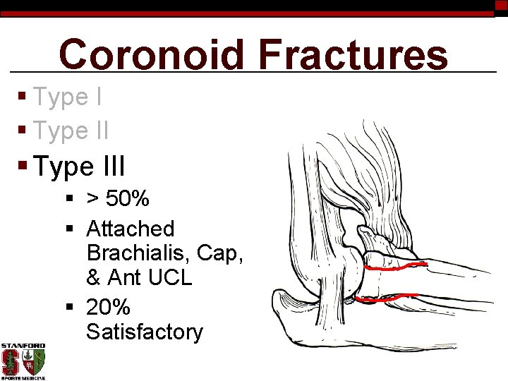 Coronoid Fractures § Type III § > 50% § Attached Brachialis, Cap, & Ant