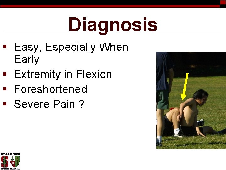 Diagnosis § Easy, Especially When Early § Extremity in Flexion § Foreshortened § Severe