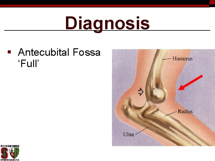 Diagnosis § Antecubital Fossa ‘Full’ 