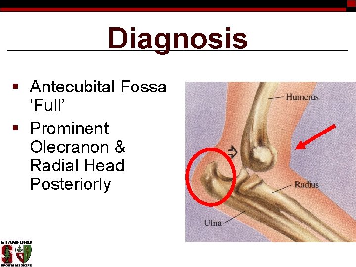Diagnosis § Antecubital Fossa ‘Full’ § Prominent Olecranon & Radial Head Posteriorly 