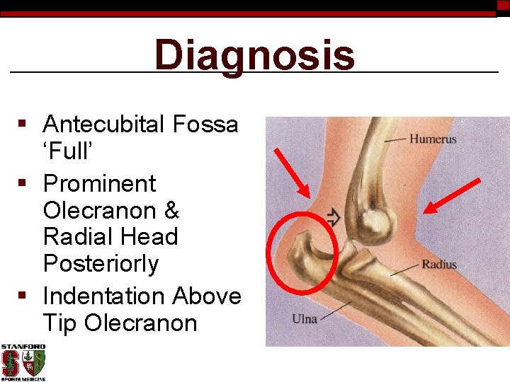 Diagnosis § Antecubital Fossa ‘Full’ § Prominent Olecranon & Radial Head Posteriorly § Indentation