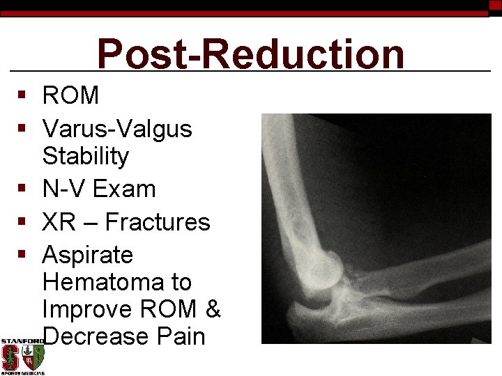 Post-Reduction § ROM § Varus-Valgus Stability § N-V Exam § XR – Fractures §