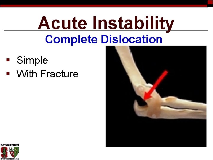 Acute Instability Complete Dislocation § Simple § With Fracture 