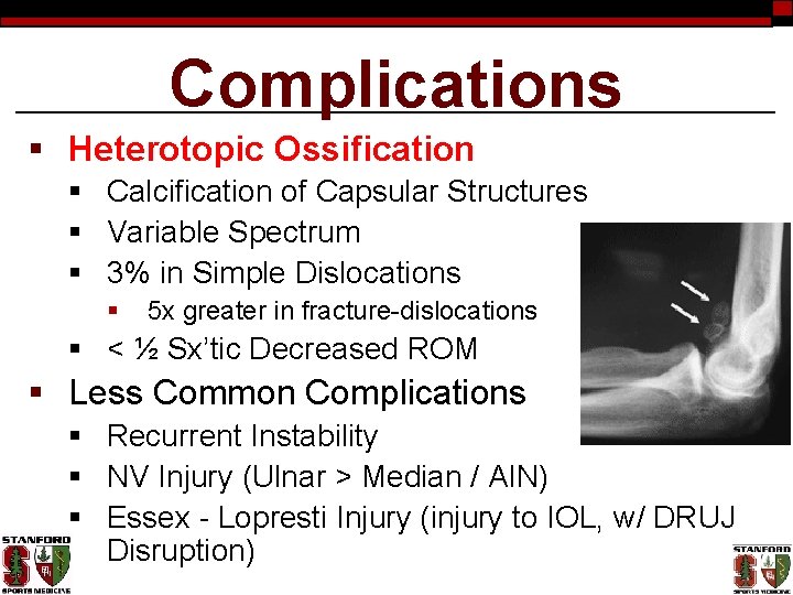 Complications § Heterotopic Ossification § Calcification of Capsular Structures § Variable Spectrum § 3%