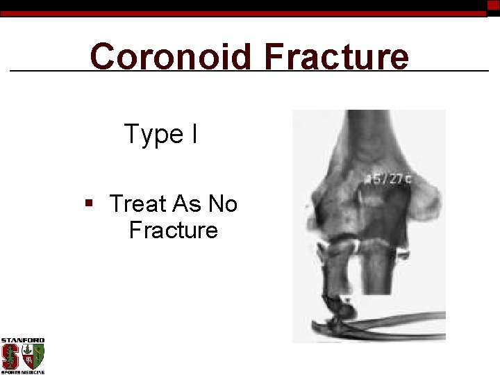 Coronoid Fracture Type I § Treat As No Fracture 