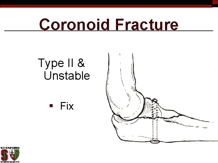 Coronoid Fracture Type II & Unstable § Fix 