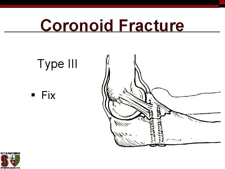 Coronoid Fracture Type III § Fix 