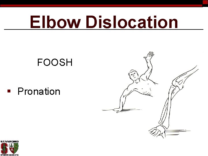 Elbow Dislocation FOOSH § Pronation 