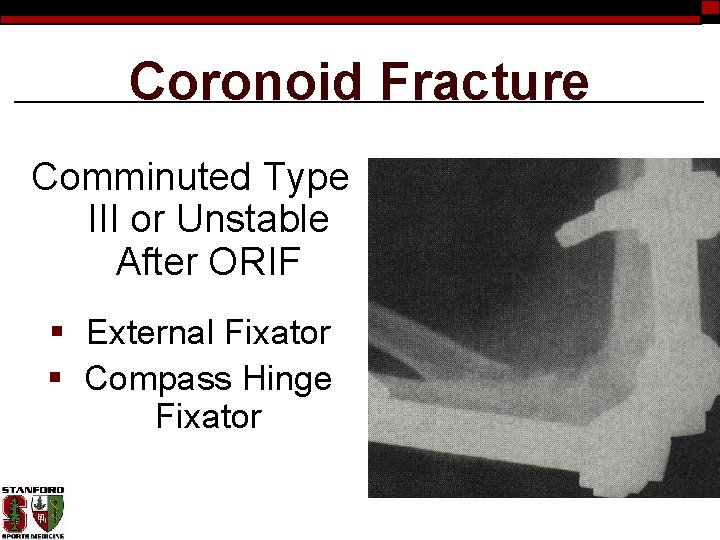 Coronoid Fracture Comminuted Type III or Unstable After ORIF § External Fixator § Compass